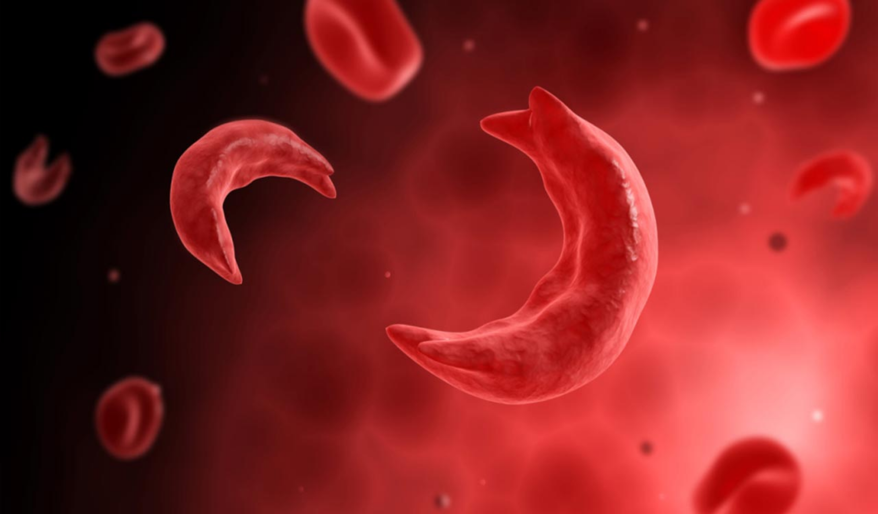 Nigeria has the highest rate of sickle cell disease in the world